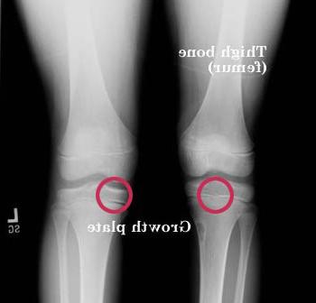 X-ray of the knees, identifying the location of the growth plates